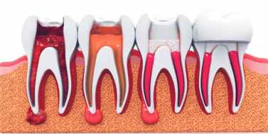 What-Exactly-Is-A-Root-Canal-377x189-1