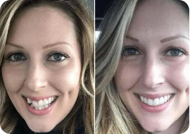 invisalign client4