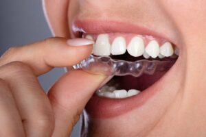 Close-up Of A Woman's Hand Putting Transparent Aligner In Teeth