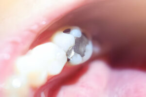 Role of Composite Filling Teeth in Perfecting Your Smile_FI