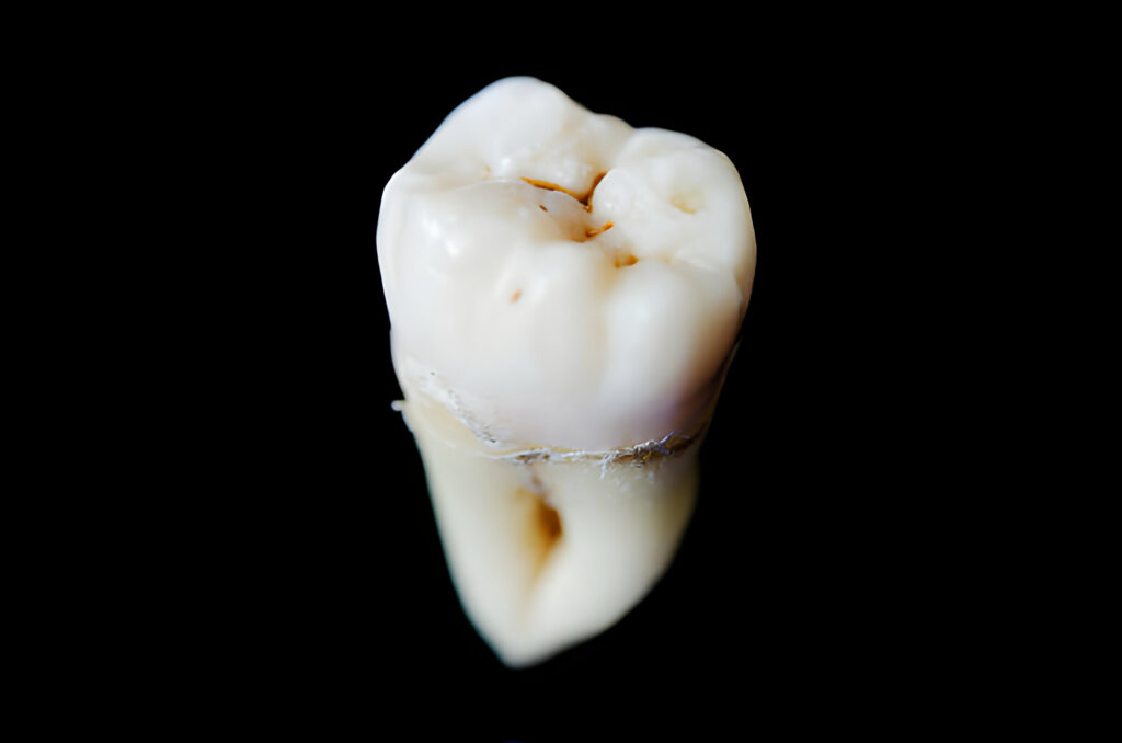The Complete Guide to Tooth Extraction: What to Expect Before, During, and After_2