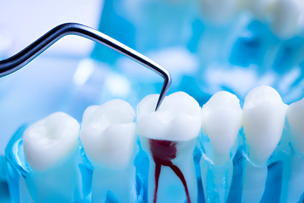 Root Canals vs. Tooth Extractions: What Dentists in Garland, TX, at Distinctive Dental Concepts Recommend_1